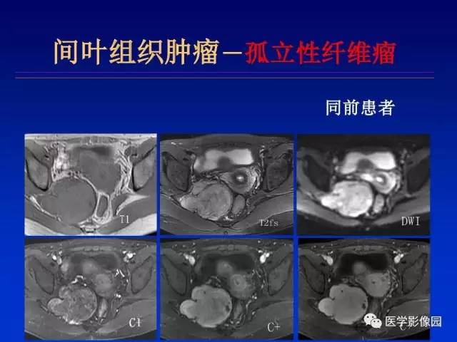 【PPT】原发腹膜后肿瘤影像表现及鉴别诊断思路