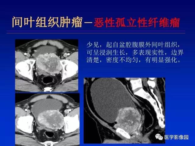 【PPT】原发腹膜后肿瘤影像表现及鉴别诊断思路