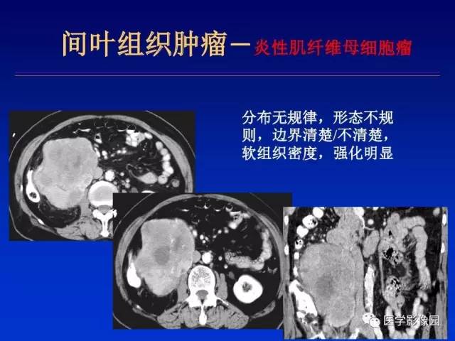 【PPT】原发腹膜后肿瘤影像表现及鉴别诊断思路