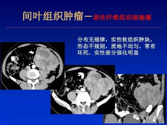 【PPT】原发腹膜后肿瘤影像表现及鉴别诊断思路