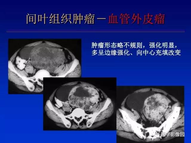 【PPT】原发腹膜后肿瘤影像表现及鉴别诊断思路
