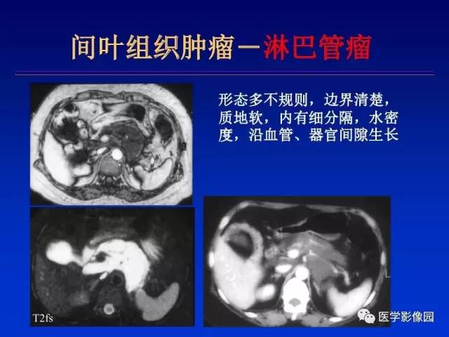 【PPT】原发腹膜后肿瘤影像表现及鉴别诊断思路