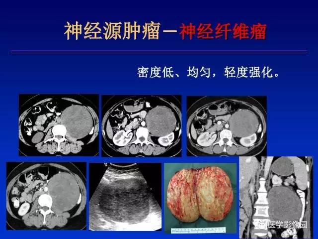 【PPT】原发腹膜后肿瘤影像表现及鉴别诊断思路
