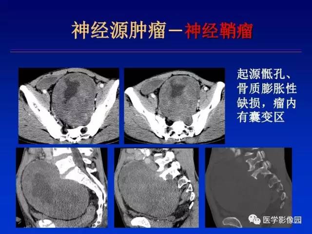 【PPT】原发腹膜后肿瘤影像表现及鉴别诊断思路