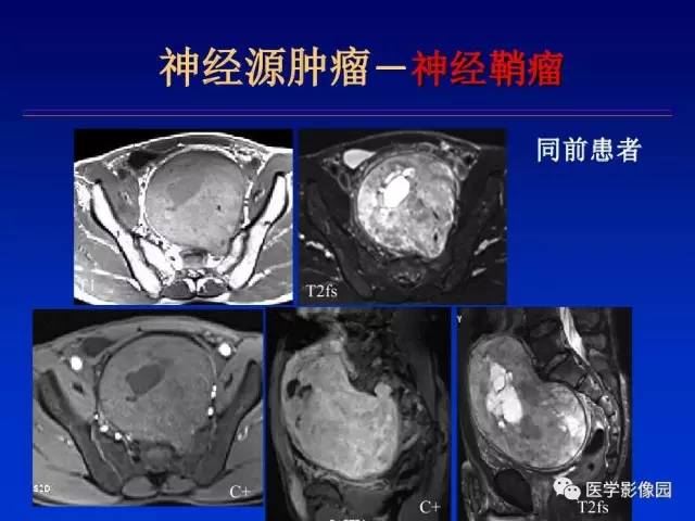 【PPT】原发腹膜后肿瘤影像表现及鉴别诊断思路