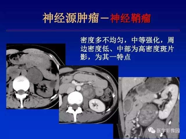 【PPT】原发腹膜后肿瘤影像表现及鉴别诊断思路