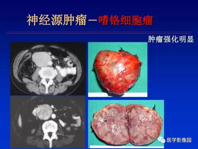 【PPT】原发腹膜后肿瘤影像表现及鉴别诊断思路