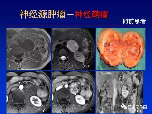 【PPT】原发腹膜后肿瘤影像表现及鉴别诊断思路