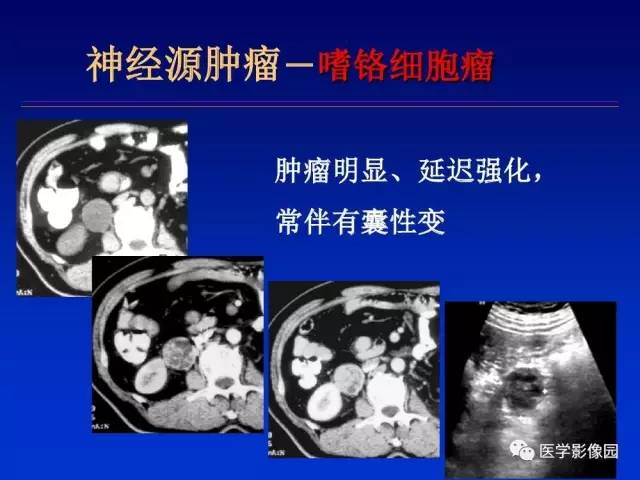 【PPT】原发腹膜后肿瘤影像表现及鉴别诊断思路
