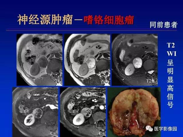 【PPT】原发腹膜后肿瘤影像表现及鉴别诊断思路