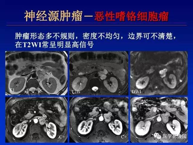 【PPT】原发腹膜后肿瘤影像表现及鉴别诊断思路