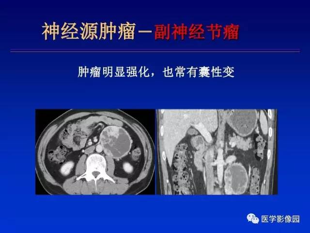 【PPT】原发腹膜后肿瘤影像表现及鉴别诊断思路