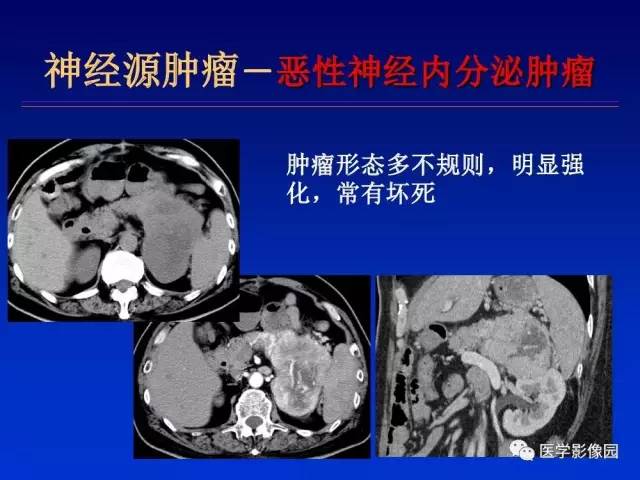 【PPT】原发腹膜后肿瘤影像表现及鉴别诊断思路