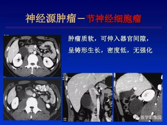 【PPT】原发腹膜后肿瘤影像表现及鉴别诊断思路