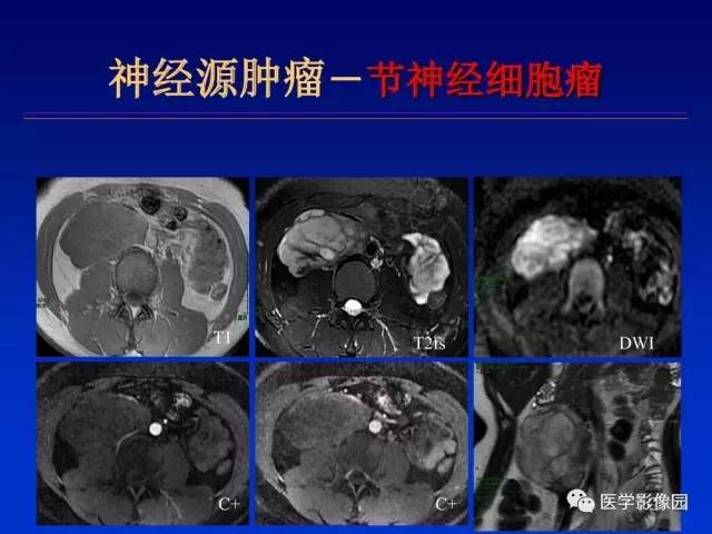 【PPT】原发腹膜后肿瘤影像表现及鉴别诊断思路