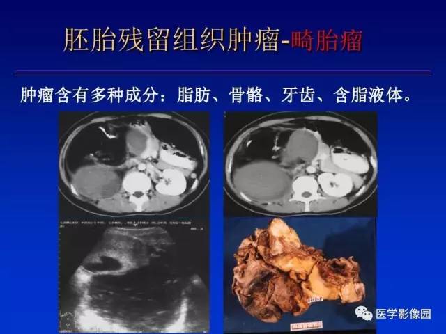 【PPT】原发腹膜后肿瘤影像表现及鉴别诊断思路