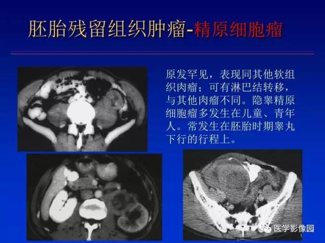 【PPT】原发腹膜后肿瘤影像表现及鉴别诊断思路