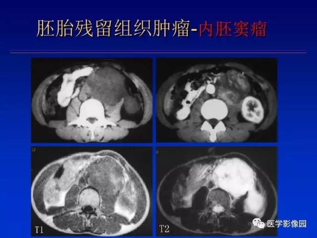 【PPT】原发腹膜后肿瘤影像表现及鉴别诊断思路
