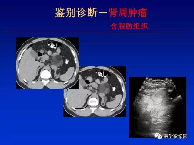 【PPT】原发腹膜后肿瘤影像表现及鉴别诊断思路