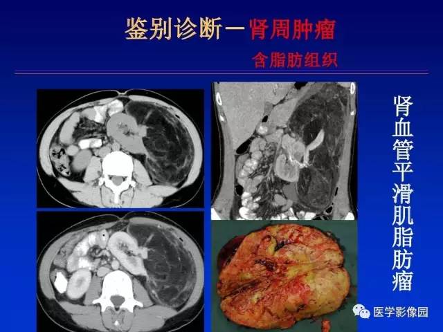 【PPT】原发腹膜后肿瘤影像表现及鉴别诊断思路