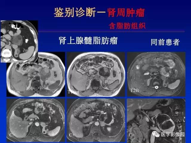 【PPT】原发腹膜后肿瘤影像表现及鉴别诊断思路