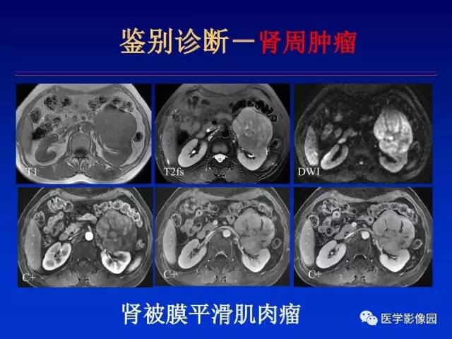 【PPT】原发腹膜后肿瘤影像表现及鉴别诊断思路