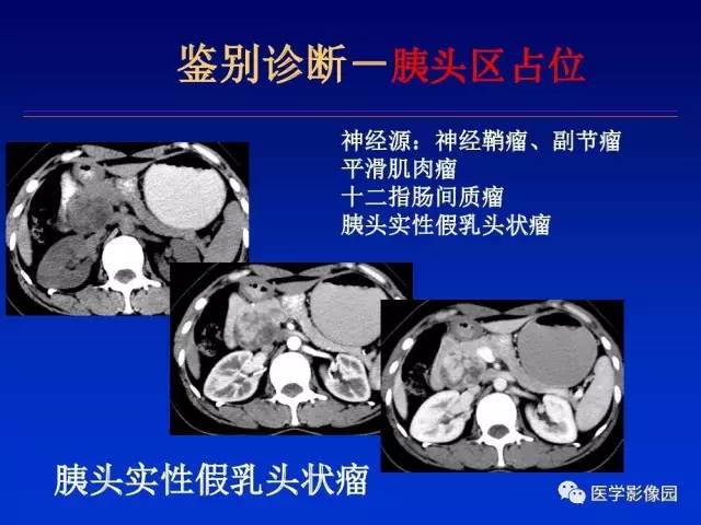 【PPT】原发腹膜后肿瘤影像表现及鉴别诊断思路