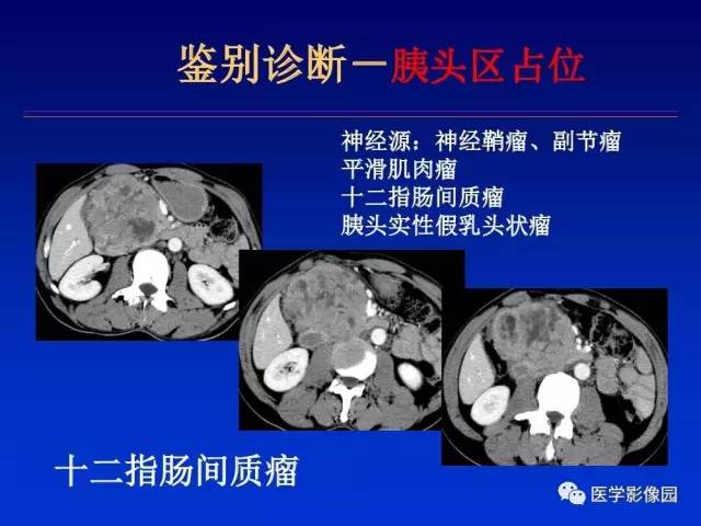 【PPT】原发腹膜后肿瘤影像表现及鉴别诊断思路