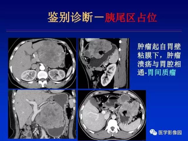 【PPT】原发腹膜后肿瘤影像表现及鉴别诊断思路