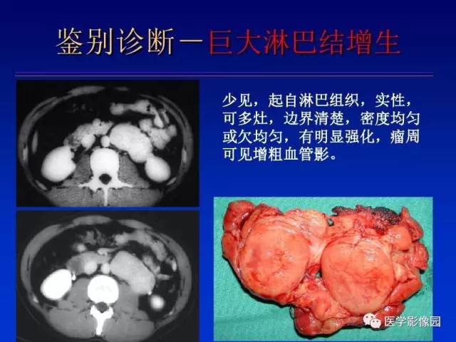 【PPT】原发腹膜后肿瘤影像表现及鉴别诊断思路