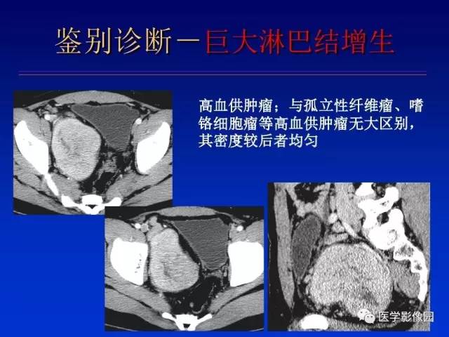 【PPT】原发腹膜后肿瘤影像表现及鉴别诊断思路