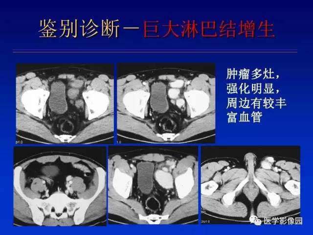 【PPT】原发腹膜后肿瘤影像表现及鉴别诊断思路