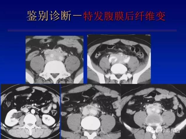 【PPT】原发腹膜后肿瘤影像表现及鉴别诊断思路