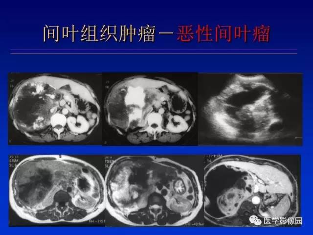 【PPT】原发腹膜后肿瘤影像表现及鉴别诊断思路