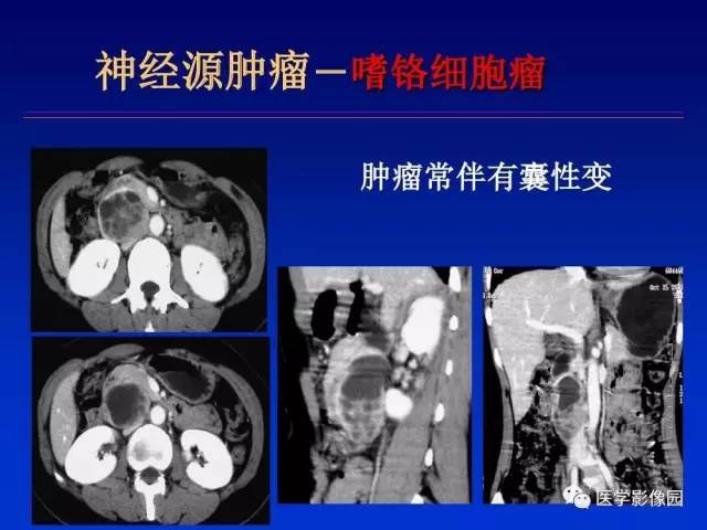 【PPT】原发腹膜后肿瘤影像表现及鉴别诊断思路