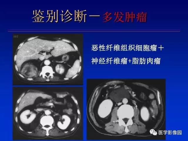 【PPT】原发腹膜后肿瘤影像表现及鉴别诊断思路