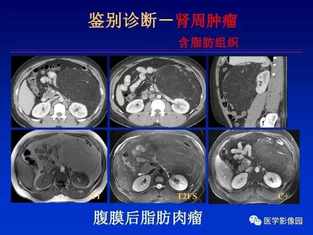 【PPT】原发腹膜后肿瘤影像表现及鉴别诊断思路