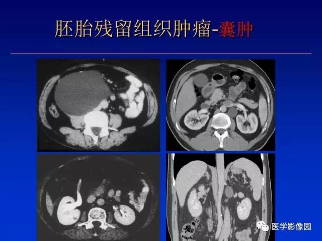 【PPT】原发腹膜后肿瘤影像表现及鉴别诊断思路