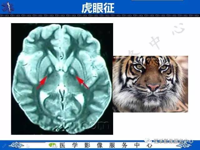 【影像征象】虎眼征