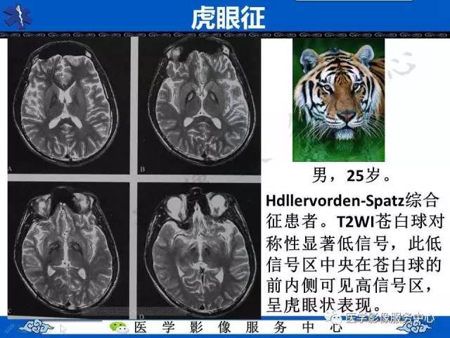 【影像征象】虎眼征