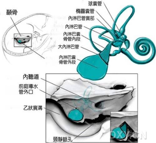你听都没有听过的——内淋巴囊瘤 你听都没有听过的——内淋巴囊瘤