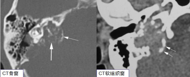 你听都没有听过的——内淋巴囊瘤