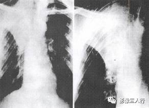 “逆S征” 的影像表现与临床意义 “逆S征” 的影像表现与临床意义