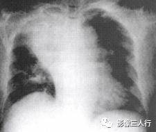 “逆S征” 的影像表现与临床意义 “逆S征” 的影像表现与临床意义