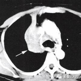 “逆S征” 的影像表现与临床意义 “逆S征” 的影像表现与临床意义