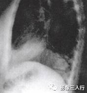 “逆S征” 的影像表现与临床意义 “逆S征” 的影像表现与临床意义