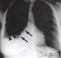 “逆S征” 的影像表现与临床意义 “逆S征” 的影像表现与临床意义