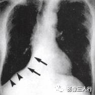 “逆S征” 的影像表现与临床意义 “逆S征” 的影像表现与临床意义