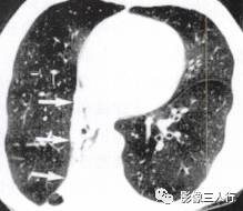 “逆S征” 的影像表现与临床意义 “逆S征” 的影像表现与临床意义