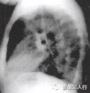 “逆S征” 的影像表现与临床意义 “逆S征” 的影像表现与临床意义